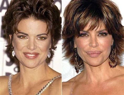 Lisa Rinna Plastic Surgery Botox Lip Fillers Photos After And Before