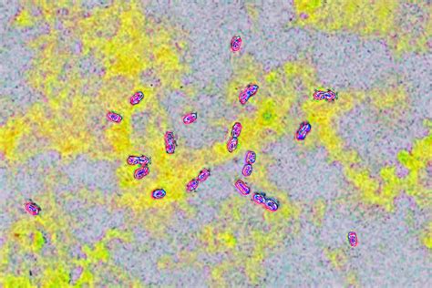 Strep A: Where are the most cases - and where have the fatal cases been?