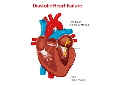 Medications For Diastolic Heart Failure