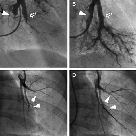 Representative Pulmonary Angiograms Before And After Balloon Pulmonary