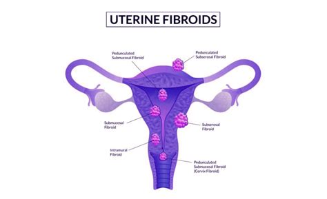Myomectomy | Surgery For Uterine Fibroids Removal | Uterine Fibroid ...