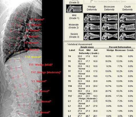 Vertebral Fracture Assessment In Supine Position Comparison By Using