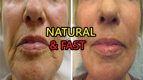 How To Get Rid Of Wrinkles Around The Mouth Naturally Fast Youtube