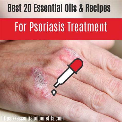 What Are The Best Essential Oils For Psoriasis And What Is The Best Psoriasis Essential Oil