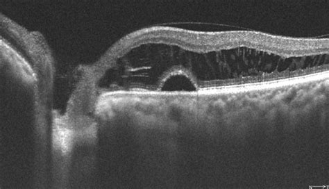 Optic Nerve Pit - Retina Image Bank