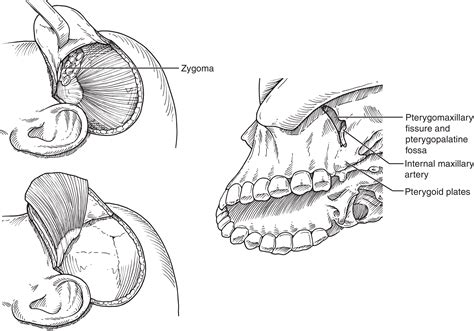 Open Resection Of Juvenile Nasopharyngeal Angiofibroma Operative