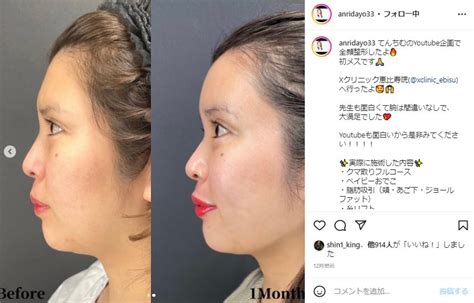 「表情が穏やかに」「マジきれい！」 坂口杏里、超ナチュラルな“全顔整形”のビフォーアフターをてんちむ絶賛 Lanri Before