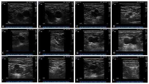 Point-Of-Care Ultrasound Screening for Proximal Lower Extremity Deep ...