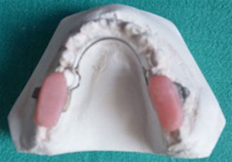 8 Step Fixed Bite Block Procedure Without Cementation Offers Multiple