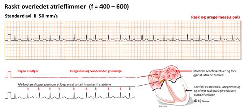 Atrieflimmer Sees Ofte I Forl Pet Av Et Hjerteinfarkt Og Postoperativt