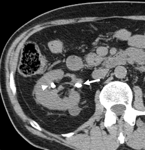 Mr Urography Techniques And Clinical Applications Radiographics