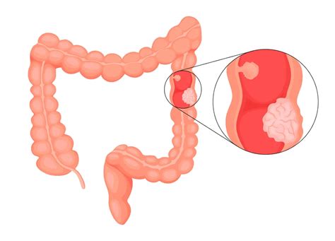 GASTROENTEROLOJİ İzmir Ekol Hastanesi