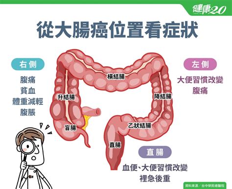 這種息肉會變癌！大腸癌症狀有哪些？吃什麼防大腸癌？原因、診斷、治療懶人包血便貧血大便習慣改變｜健康20