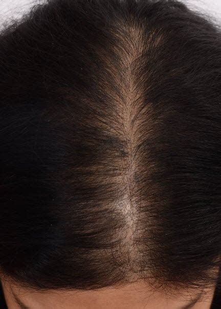 Platelet Rich Plasma Injections For Hair Restoration In Androgenic Alopecia Outcomes Cleveland