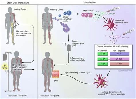 Allogeneic Bone Marrow Transplant