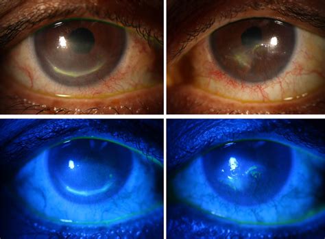 Topical Insulin For Neurotrophic Corneal Ulcers Canadian Journal Of