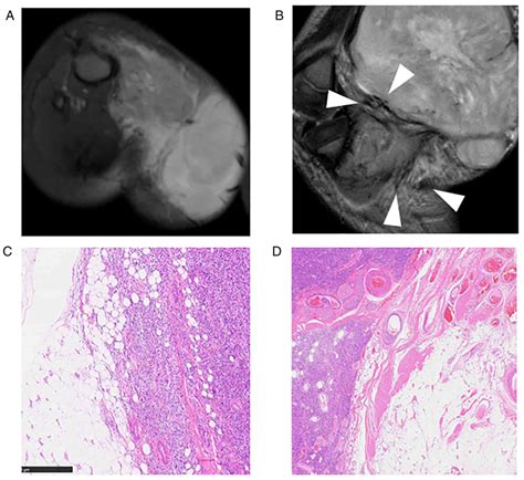 Imaging Findings Of Ntrk‑rearranged Spindle Cell Neoplasms A Case Series