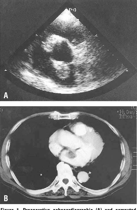 Figure 1 From Endoscope Assisted Superior Septal Approach For Resection