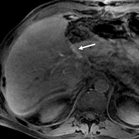 Liver Surgery Important Considerations For Pre And Postoperative