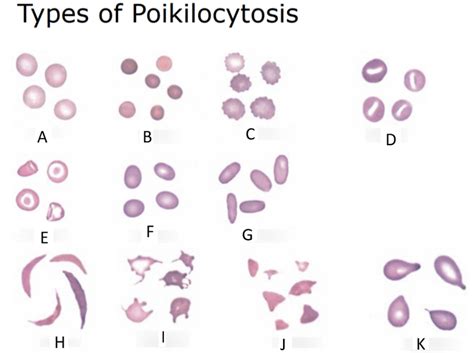 Diagram Of Diagram Poikilocytosis Quizlet