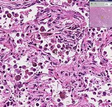 Lobar Pneumonia Histology