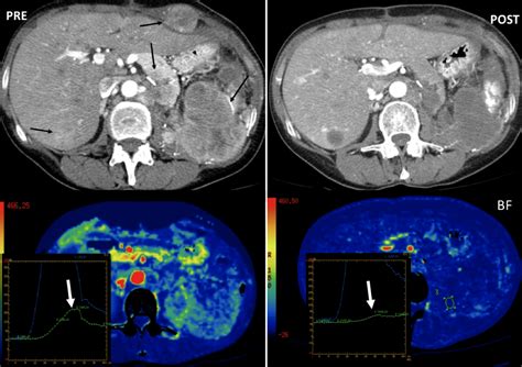 Imagen Thecniques In Renal Cell Carcinoma Intechopen