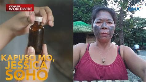 Dating Makinis Na Waitress Nasunog Nagkaroon Ng Itim Na Marka Sa