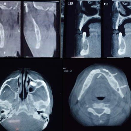 Major and minor diagnostic criterion of Gorlin-Goltz syndrome ...