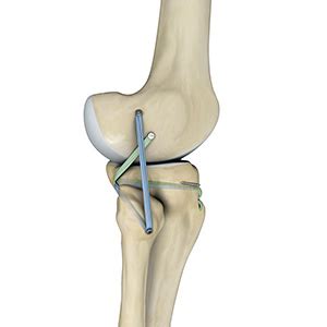 Posterolateral Corner PLC Reconstruction Baltimore Knee Surgeon