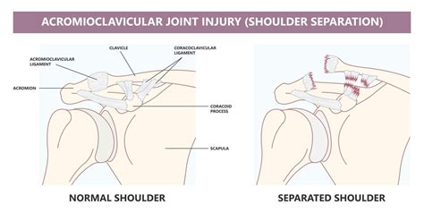 Acromioclavicular Joint Separation Physioflow Pt Physical Therapy Vancouver Wa