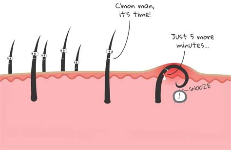 What Causes Ingrown Hairs Symptoms Treatment And Prevention