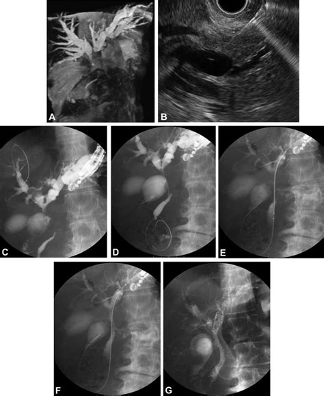 Eus Guided Antegrade Stent Placement For Unresectable Malignant Hilar