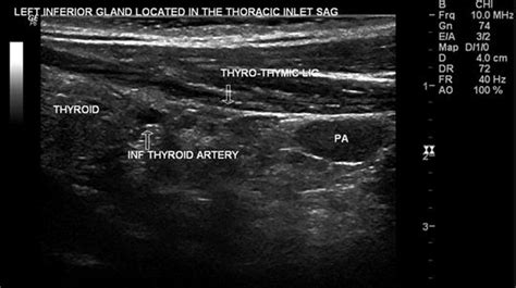 Parathyroid Gland Ultrasound