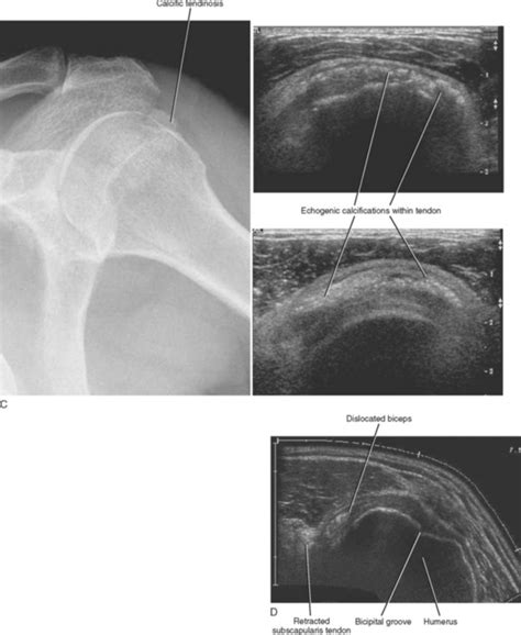 Imaging Of The Shoulder Radiology Key