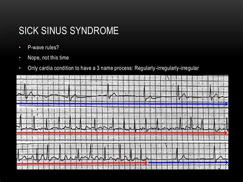 P wave axis and escape rhythms