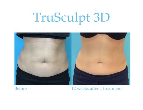 Trusculpt 3d Fairfield Dermatology