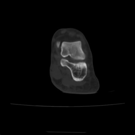 Avulsion Fracture Of The Dorsal Cuboid Bone Radiopaedia 51586 57377