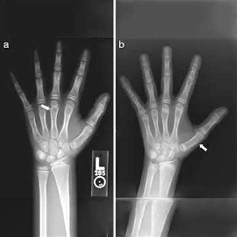 What Is The Role Of X Rays In Bone Age Study Ganesh Diagnostic