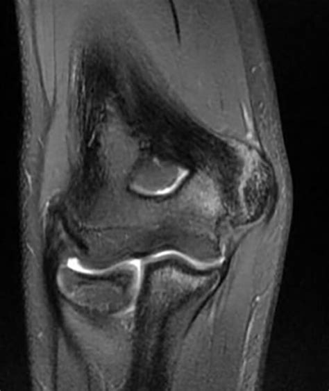 Olecranon Stress Fractures In Baseball Players Dr Christopher Ahmad