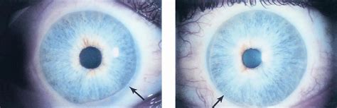 Posterior embryotoxon. - American Academy of Ophthalmology