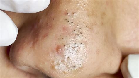 Suri Job 595 Awesome Popping Big Blackheads On Nose Youtube