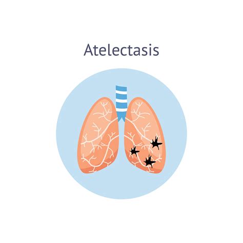 Ατελεκτασία – Wikihealth.gr