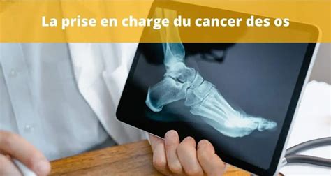 Cancer des Os Symptômes Traitements et Espérance de vie