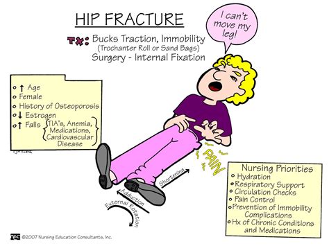 Hip Fracture Nursing Mnemonics And Tips Nursing Mnemonics Medical Surgical Nursing