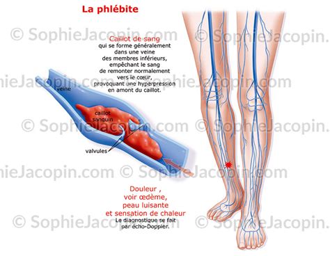 PhlÉbite Illustration Sophie Jacopin