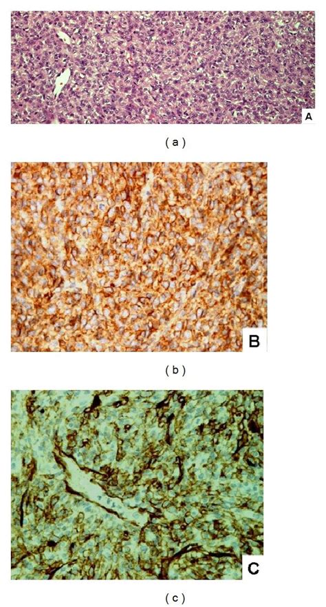 Histology and immunohistochemistry of meningeal hemangiopericytoma. (a)... | Download Scientific ...