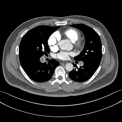 Saddle Embolus Image