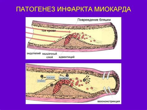 Причины и механизмы развития инфаркта миокарда - фото презентация