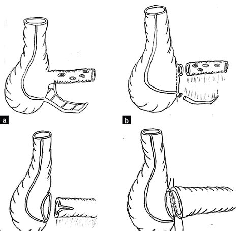 Ileocecal Resection