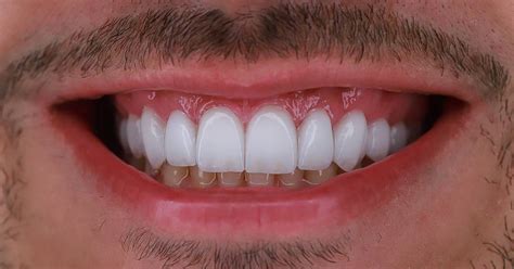 Como Colocar Lente Nos Dentes Guia Completo Do Procedimento